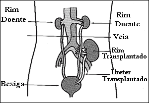 Diagrama de como é um transplante renal.